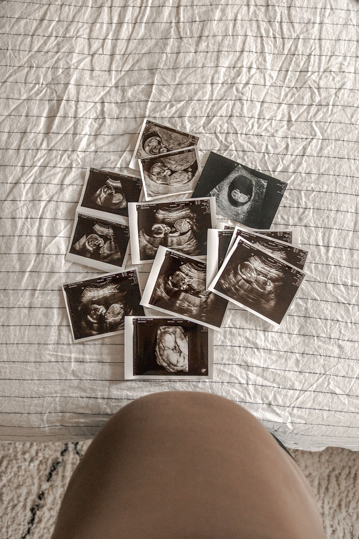Coping With Pregnancy After Loss.