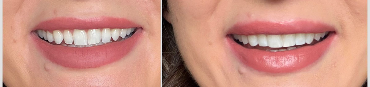 composite bonding before and after