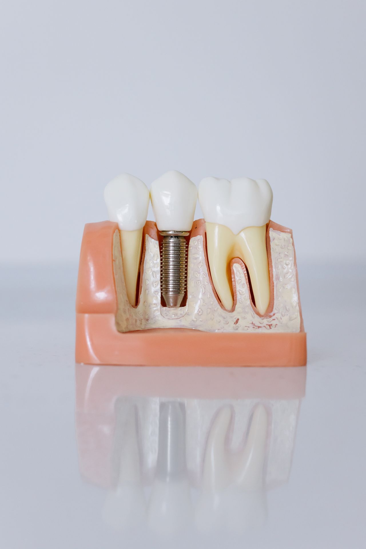 Root Canal or Extraction: Which Is Better?